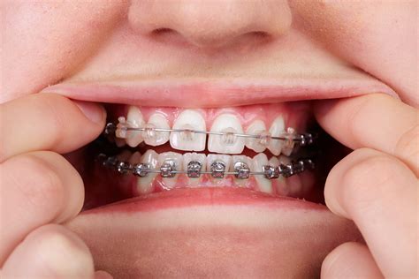 metal bracket orthodontics|metal braces with clear bands.